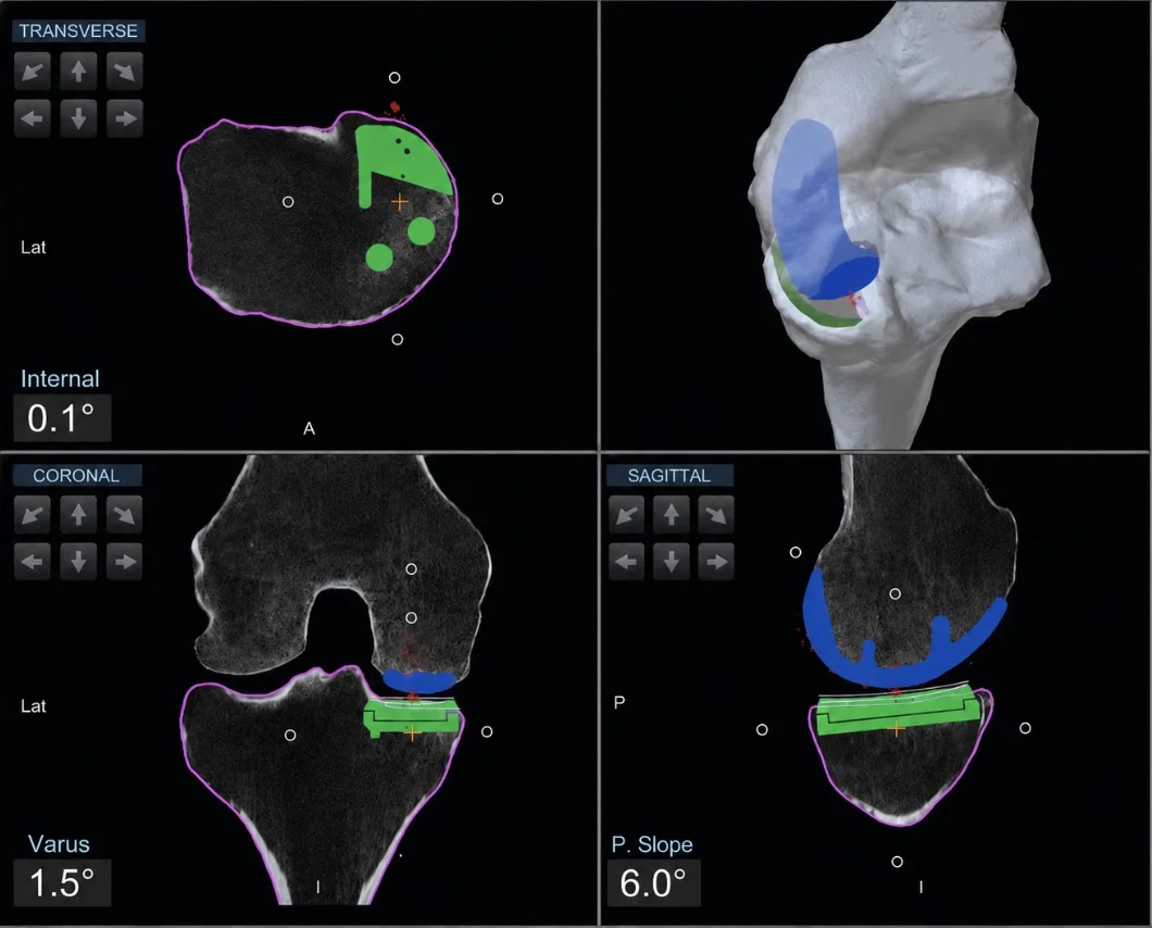 Robotic knee replacement planning software